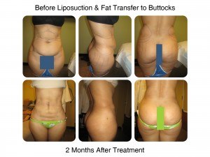 Brazilian Butt Lift