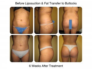 Brazilian Butt Lift