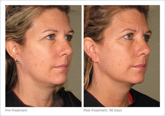 Ultherapy-Before-and-After-6