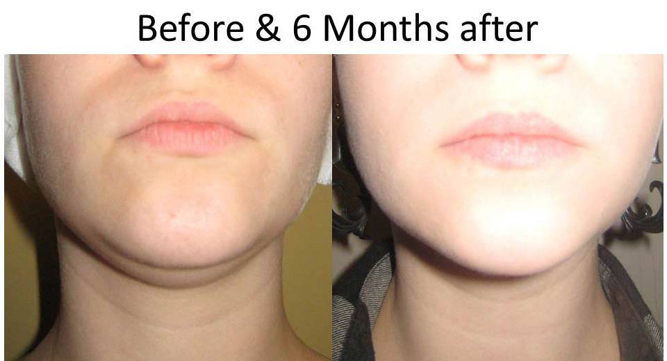 beforeandAfterLaserFacelift-1