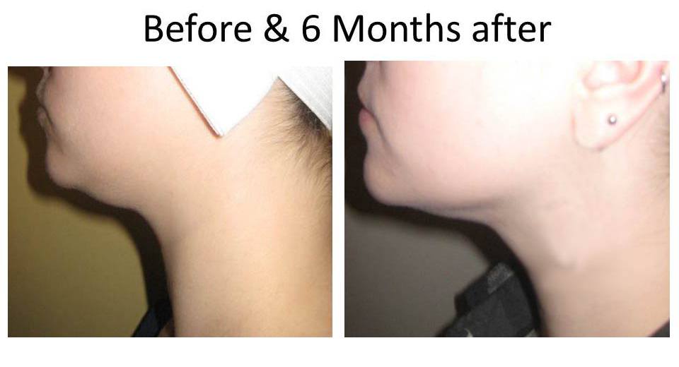 beforeandAfterLaserFacelift-2