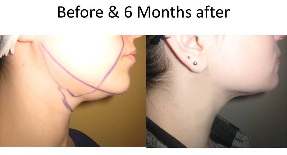 beforeandAfterLaserFacelift-3