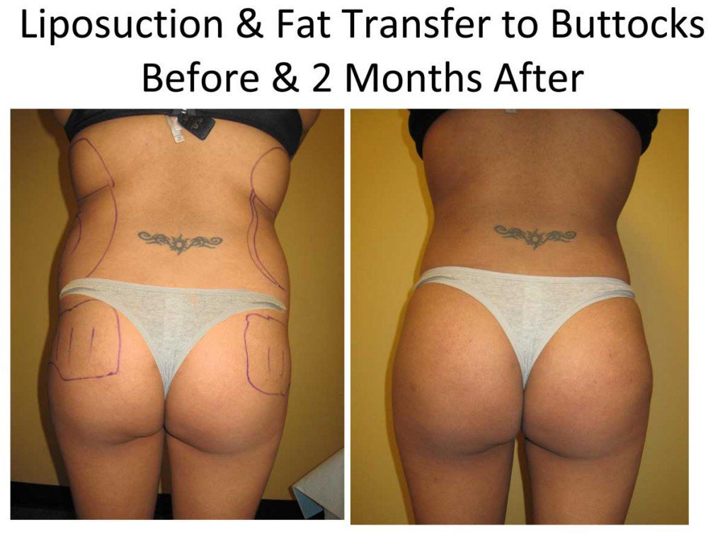 Liposuction_and_Fat_Transfer_to_Buttocks2-1