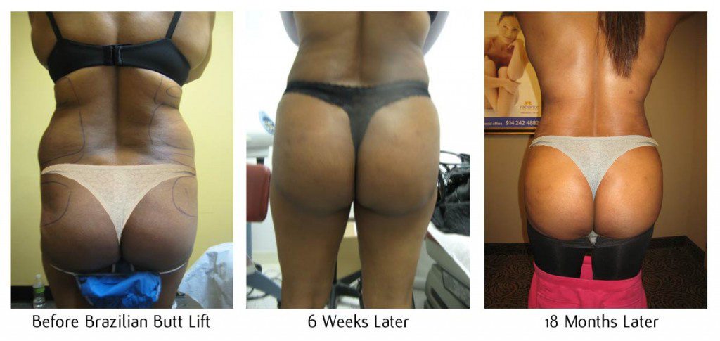 brazilianButtLiftBeforeAfter-5-1