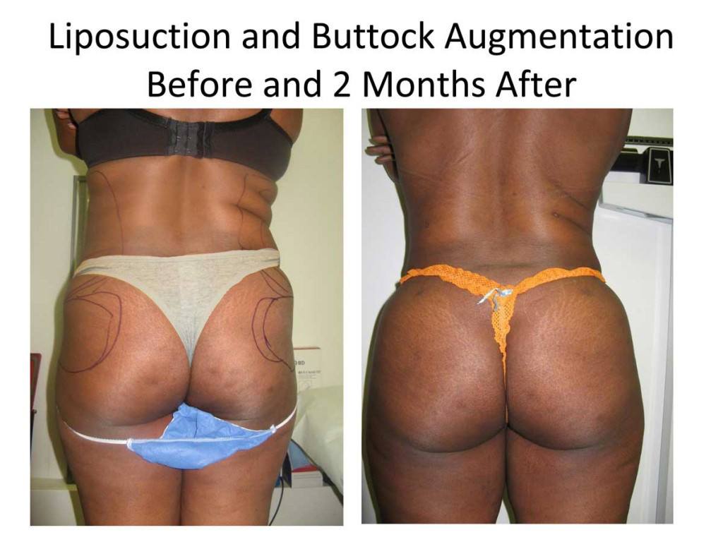 fat_transfer_to_buttocks3-1