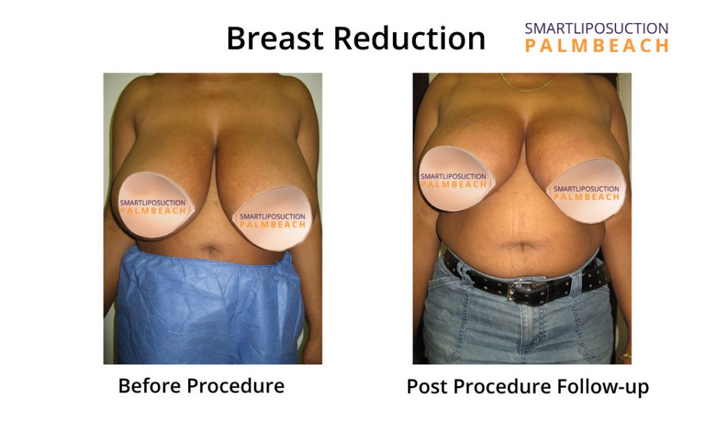 breasts1