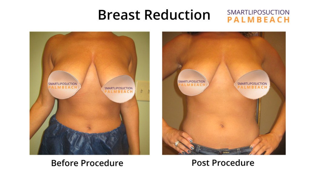 breasts3