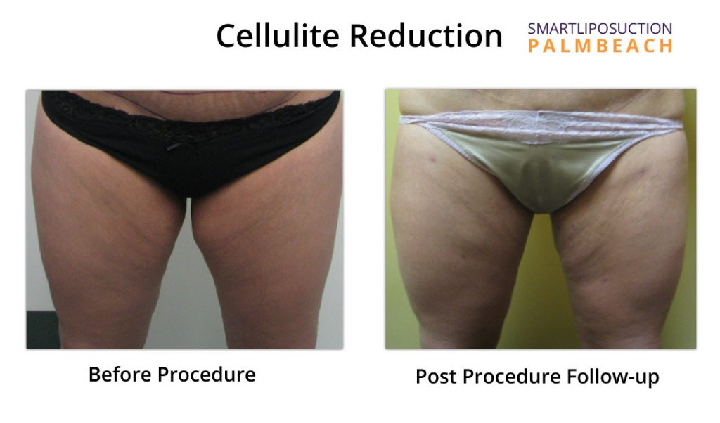 cellulite-reduction