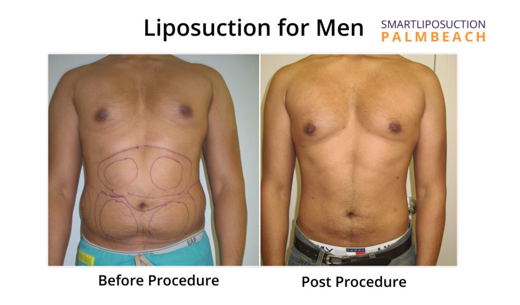 lipomen2