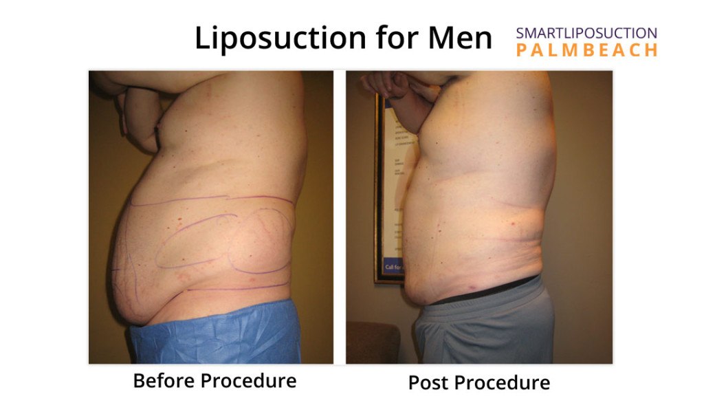 lipomen3