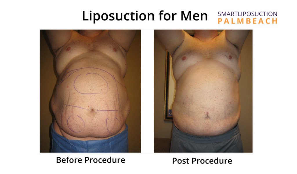 lipomen4