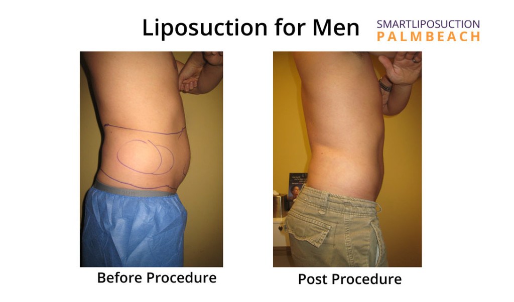 lipomen5