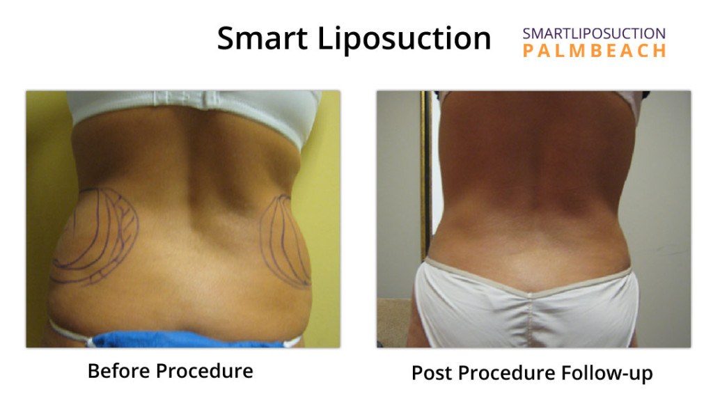 regular-lipo