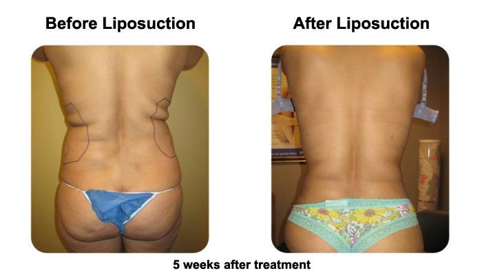 smartlipoback1