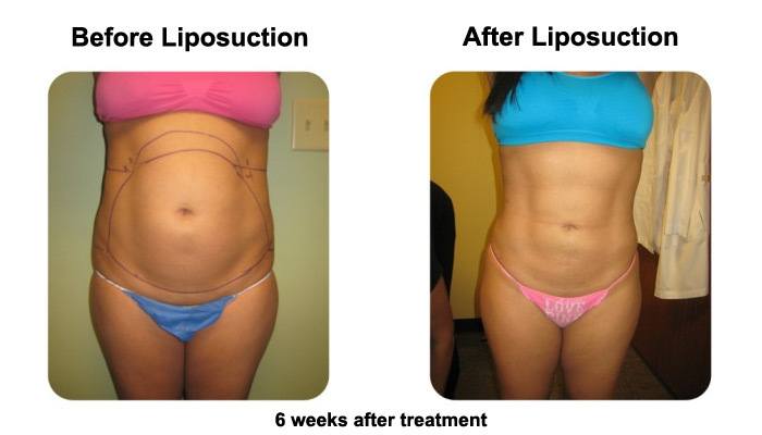 smartlipofront1