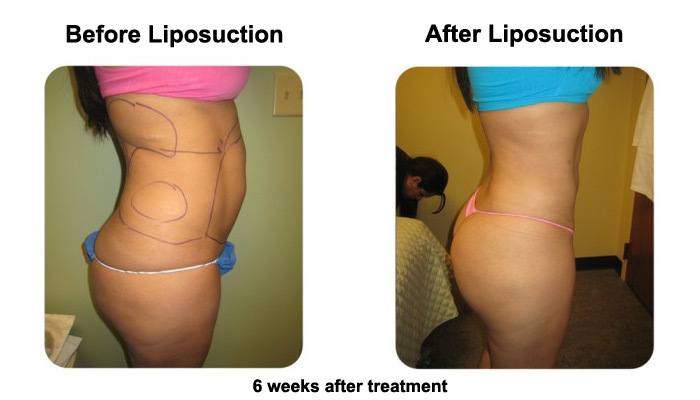 smartliposide2